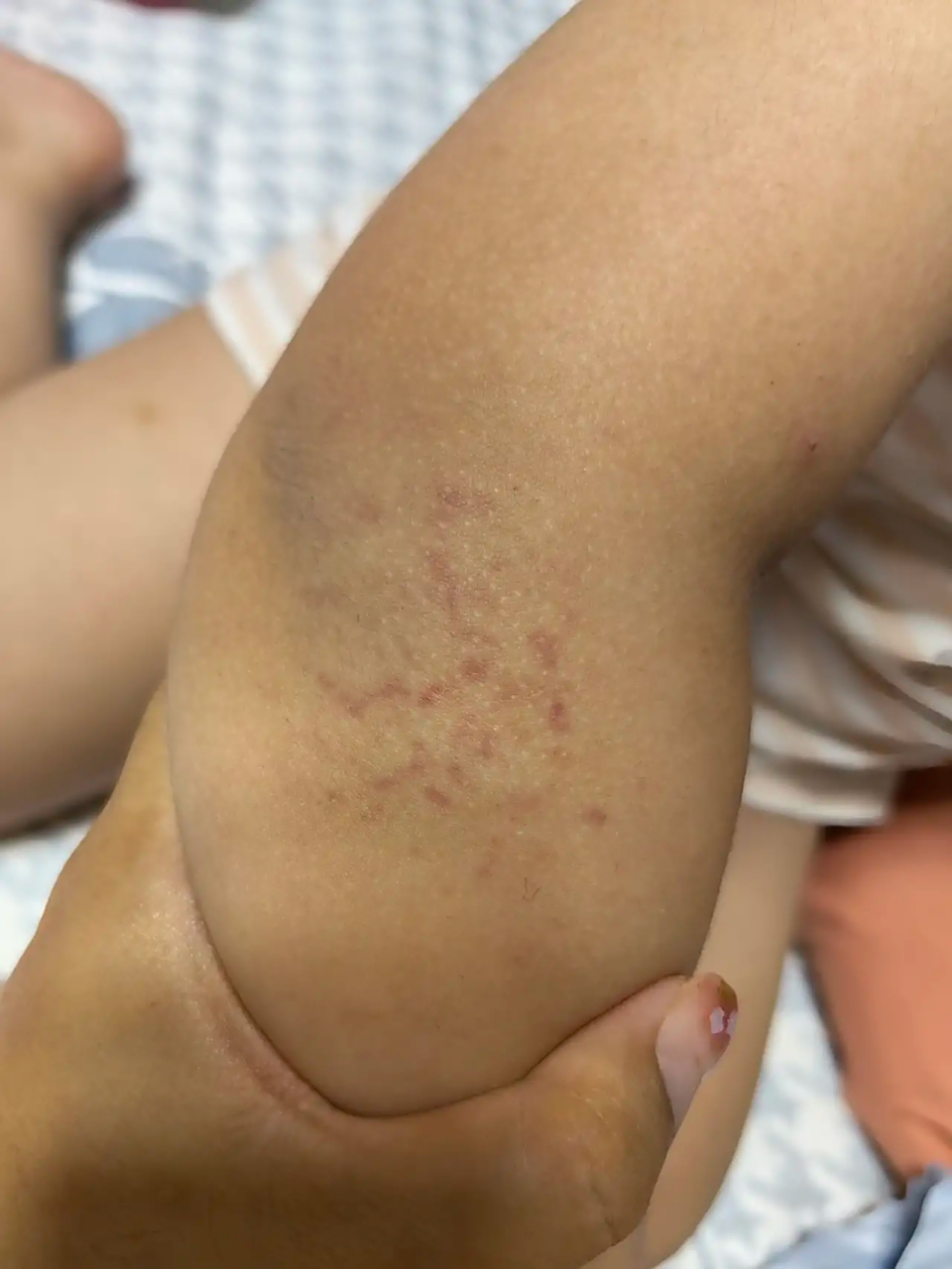 白血病在早期有哪些症状表现?