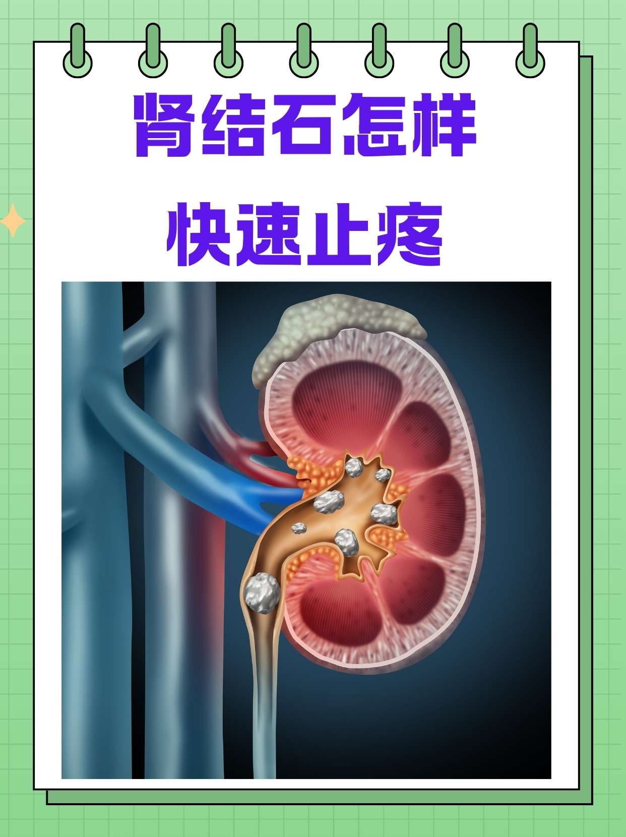 男性肾结石症状有哪些