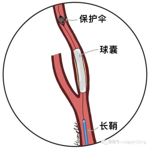 颈动脉支架手术费用