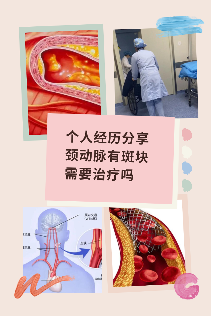 颈动脉支架手术费用