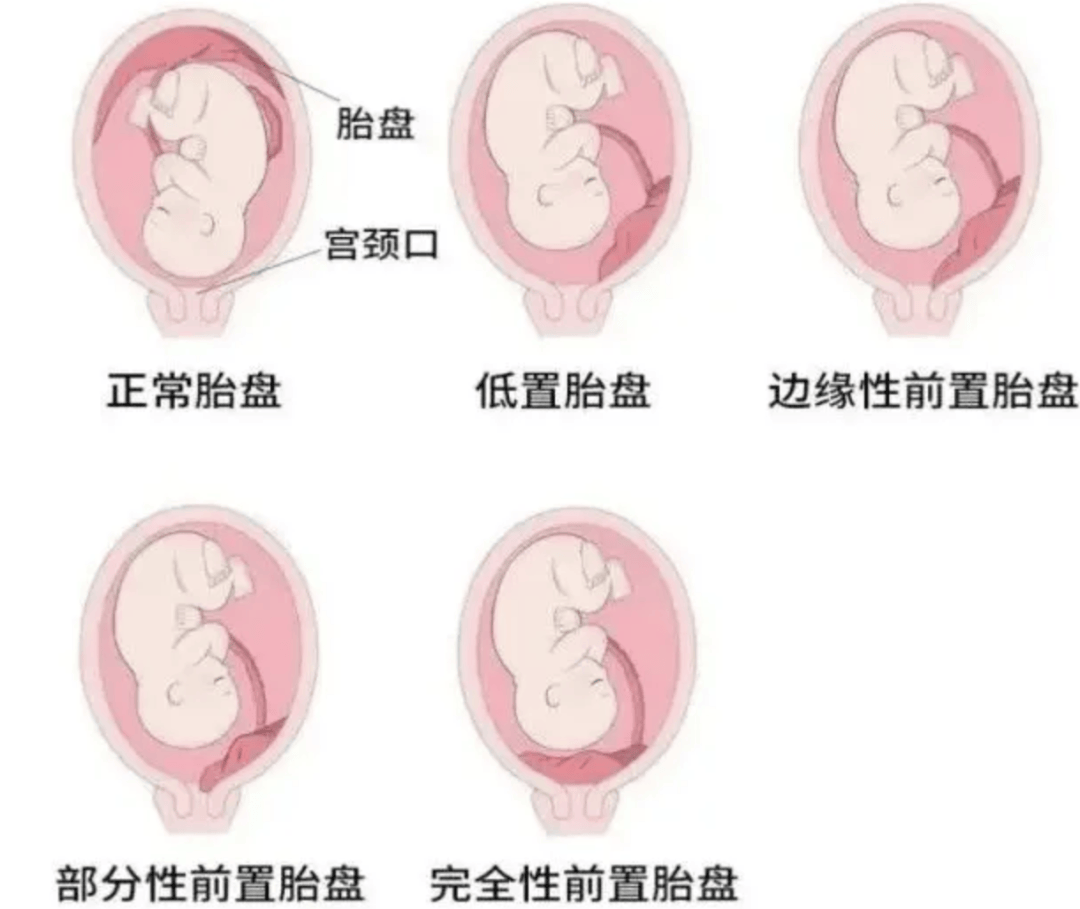 前置胎盘的病因?