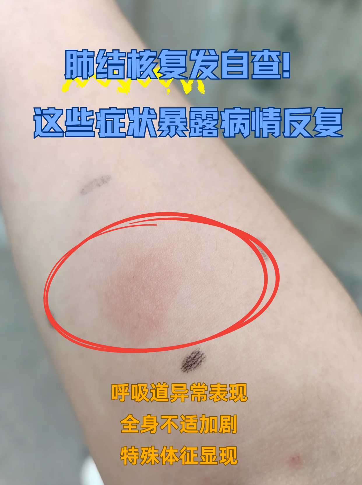 肺结核早期的症状