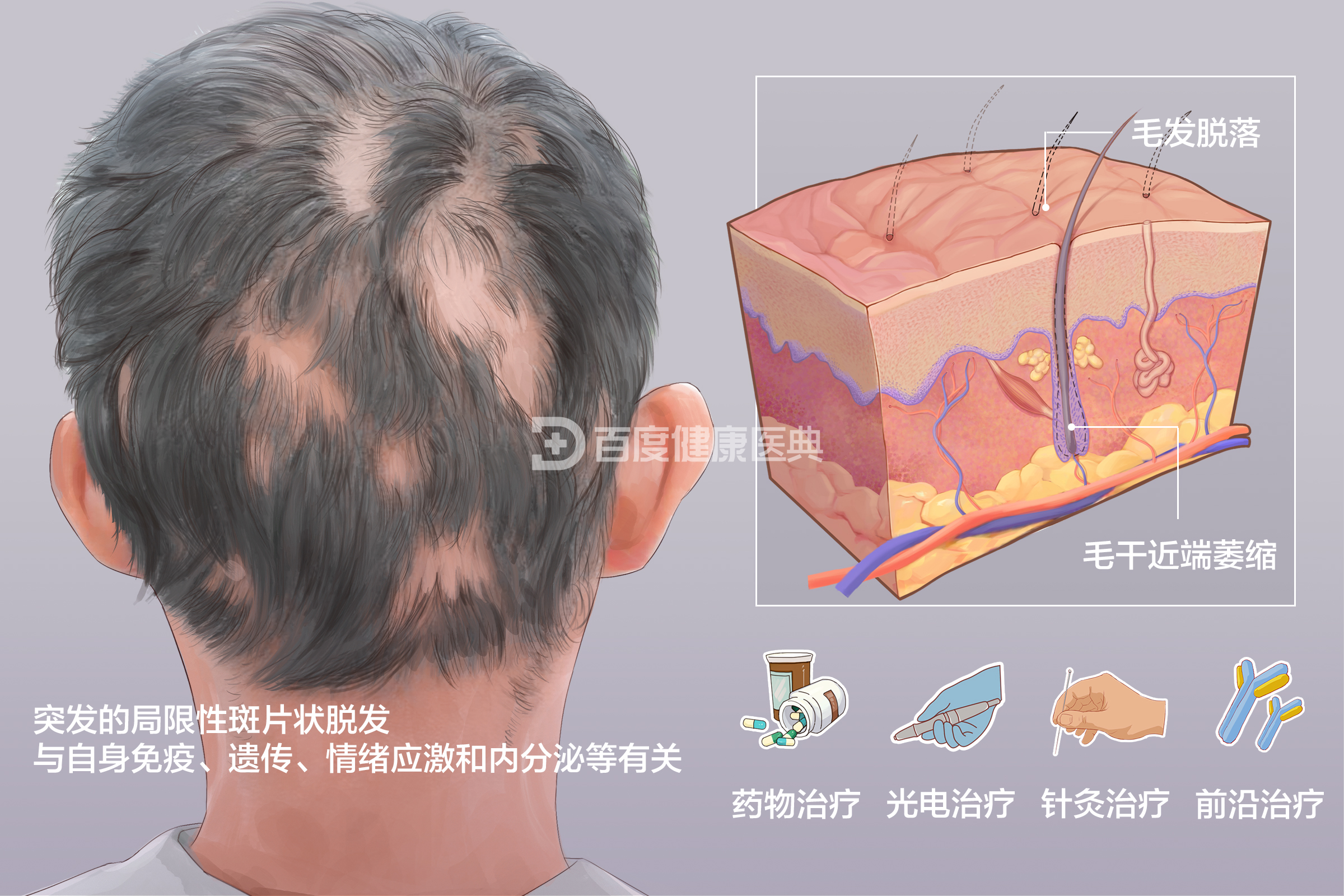 斑秃的病因有哪些?