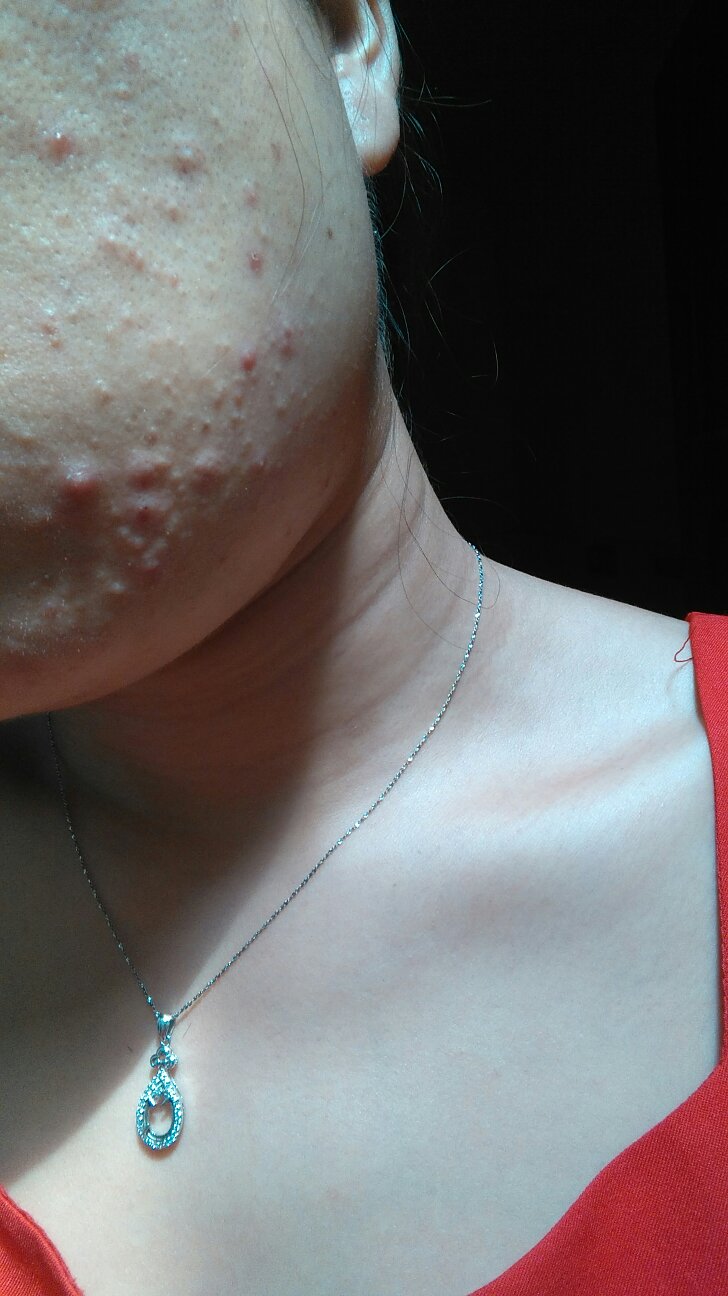 脸上的小疙瘩是什么?