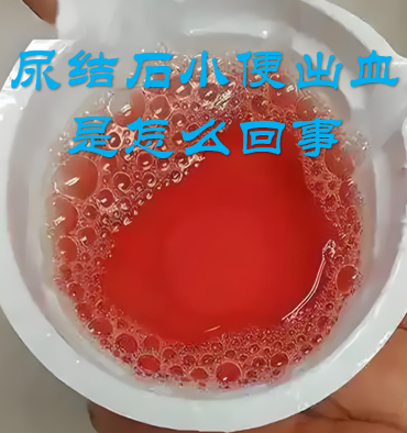 尿液呈红色,是什么原因