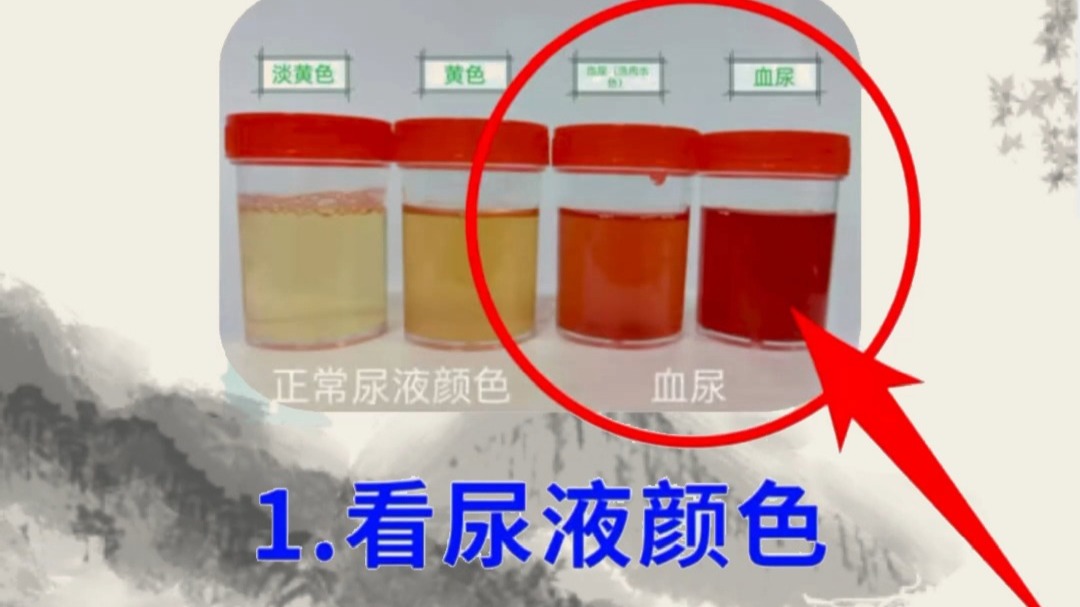 尿液呈红色,是什么原因