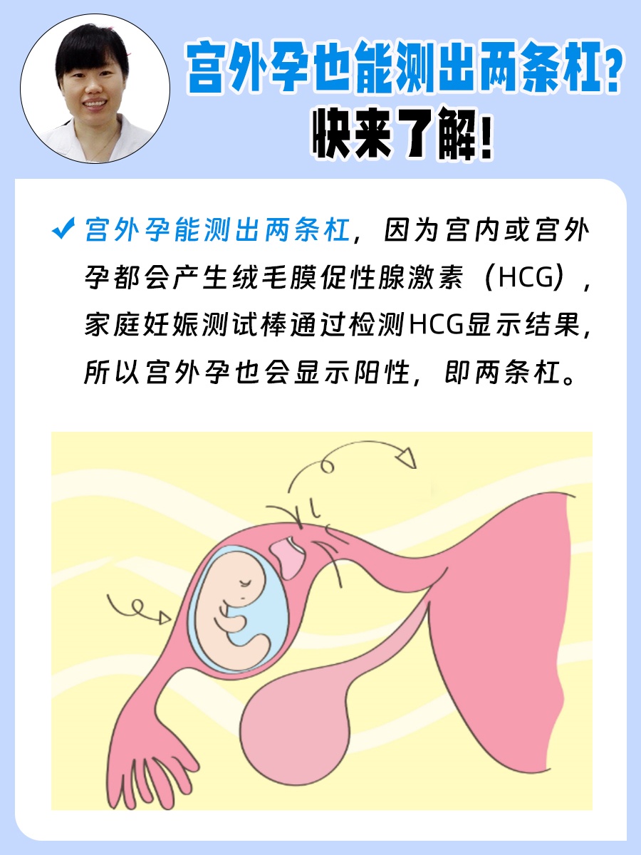 宫内孕和宫外孕的区别