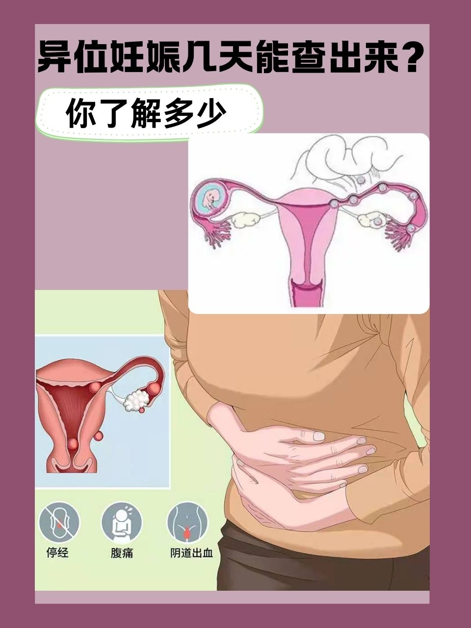 宫内孕和宫外孕的区别