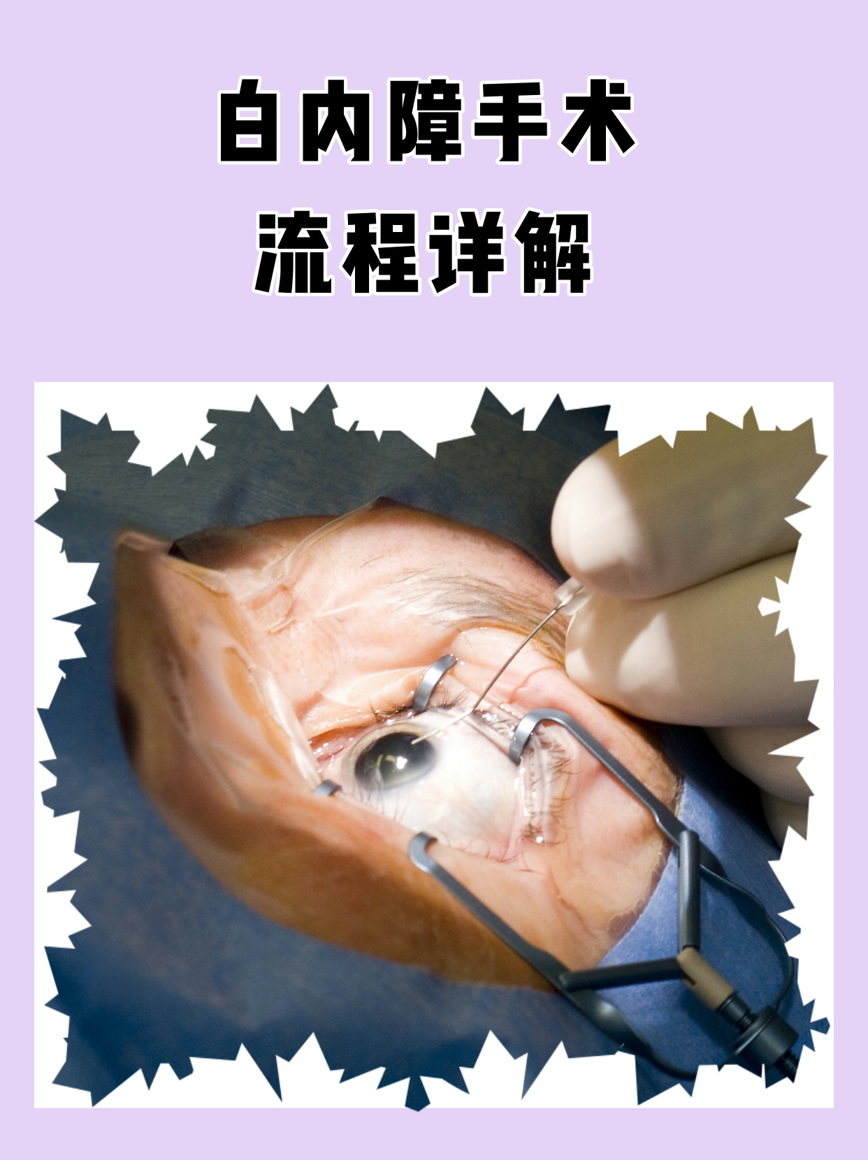 眼睛玻璃体混浊怎么治疗?