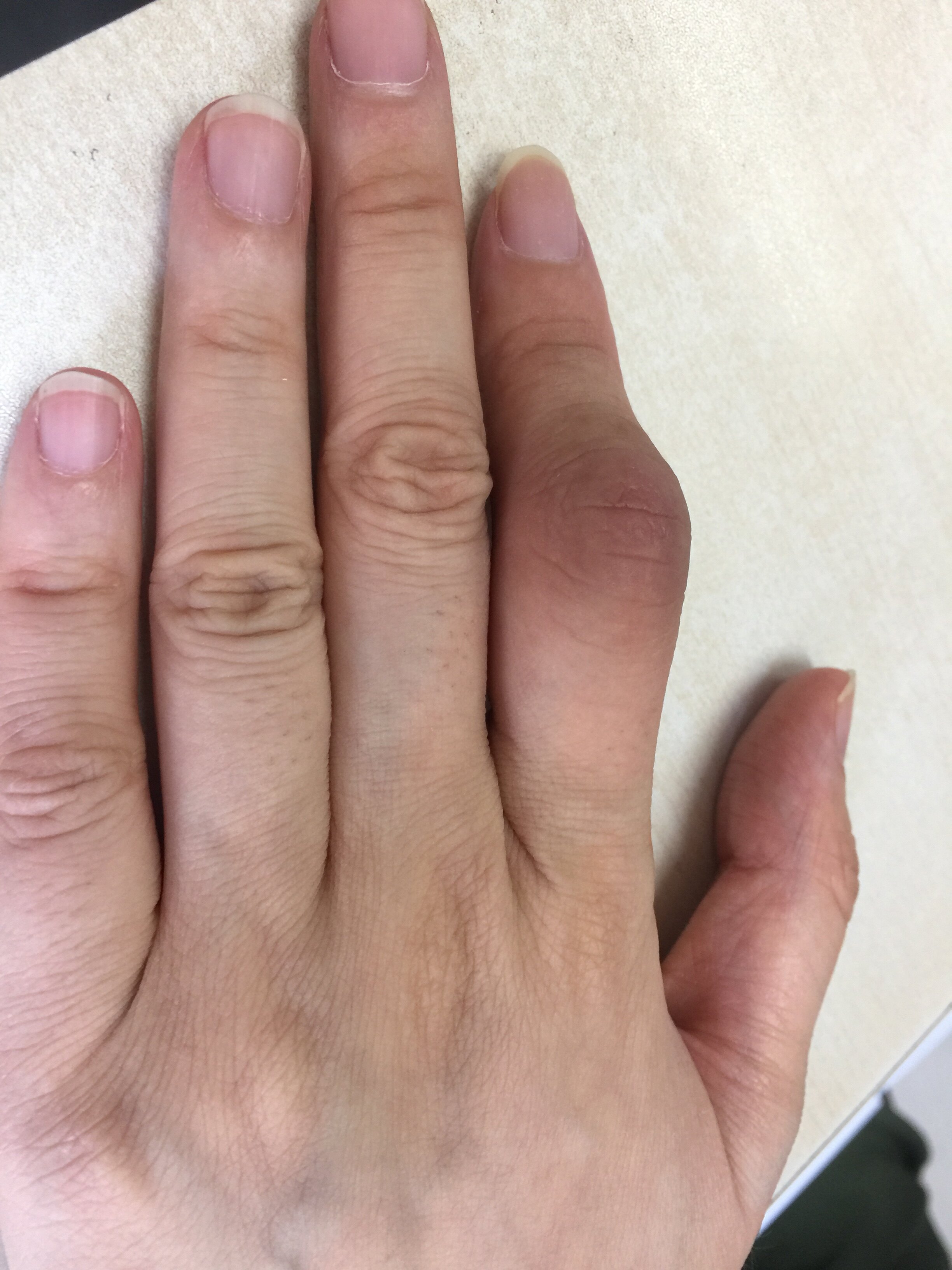 风湿类风湿是什么