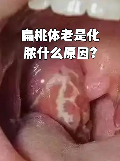 化脓性扁桃体炎症状