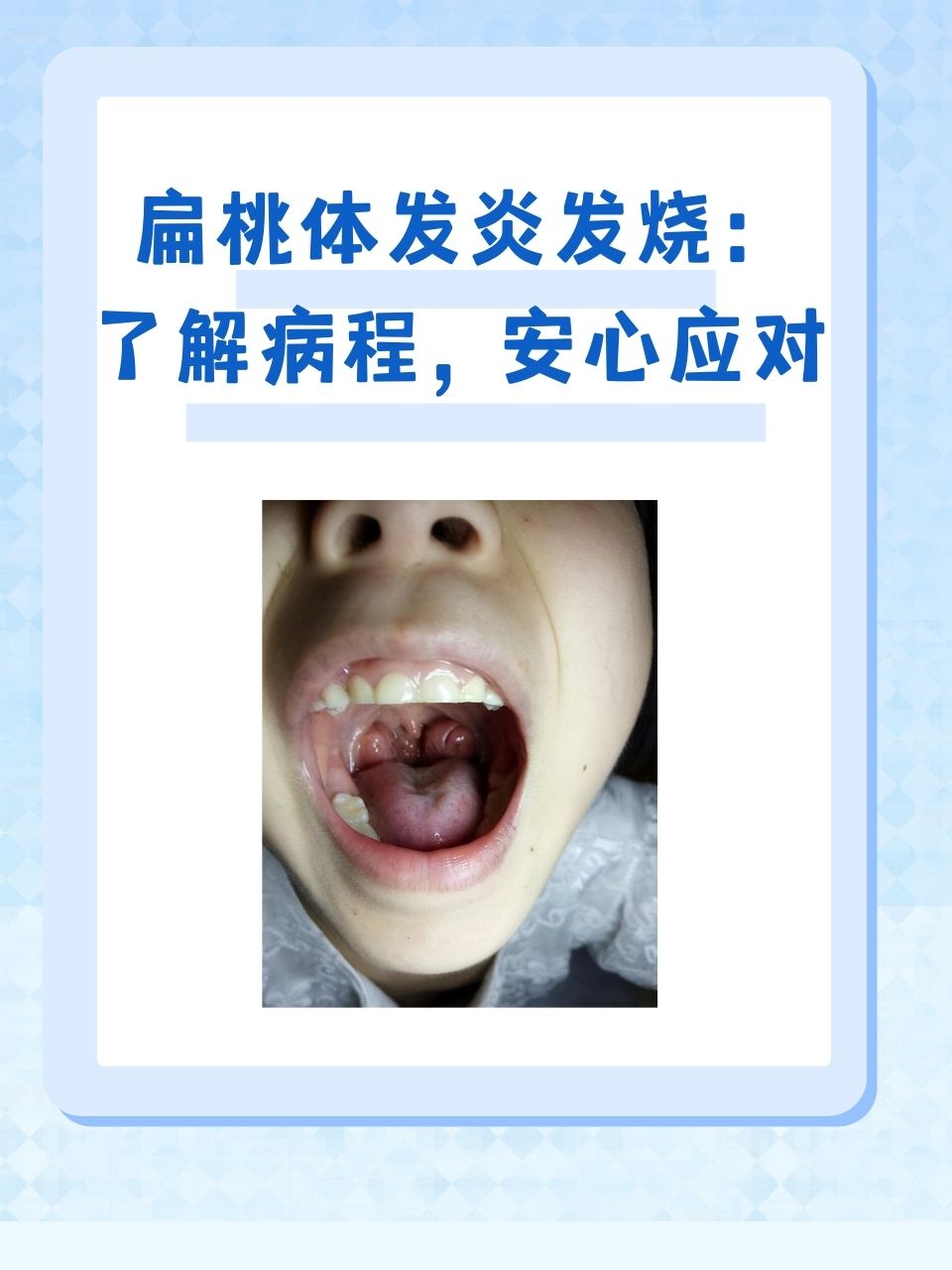 化脓性扁桃体炎症状