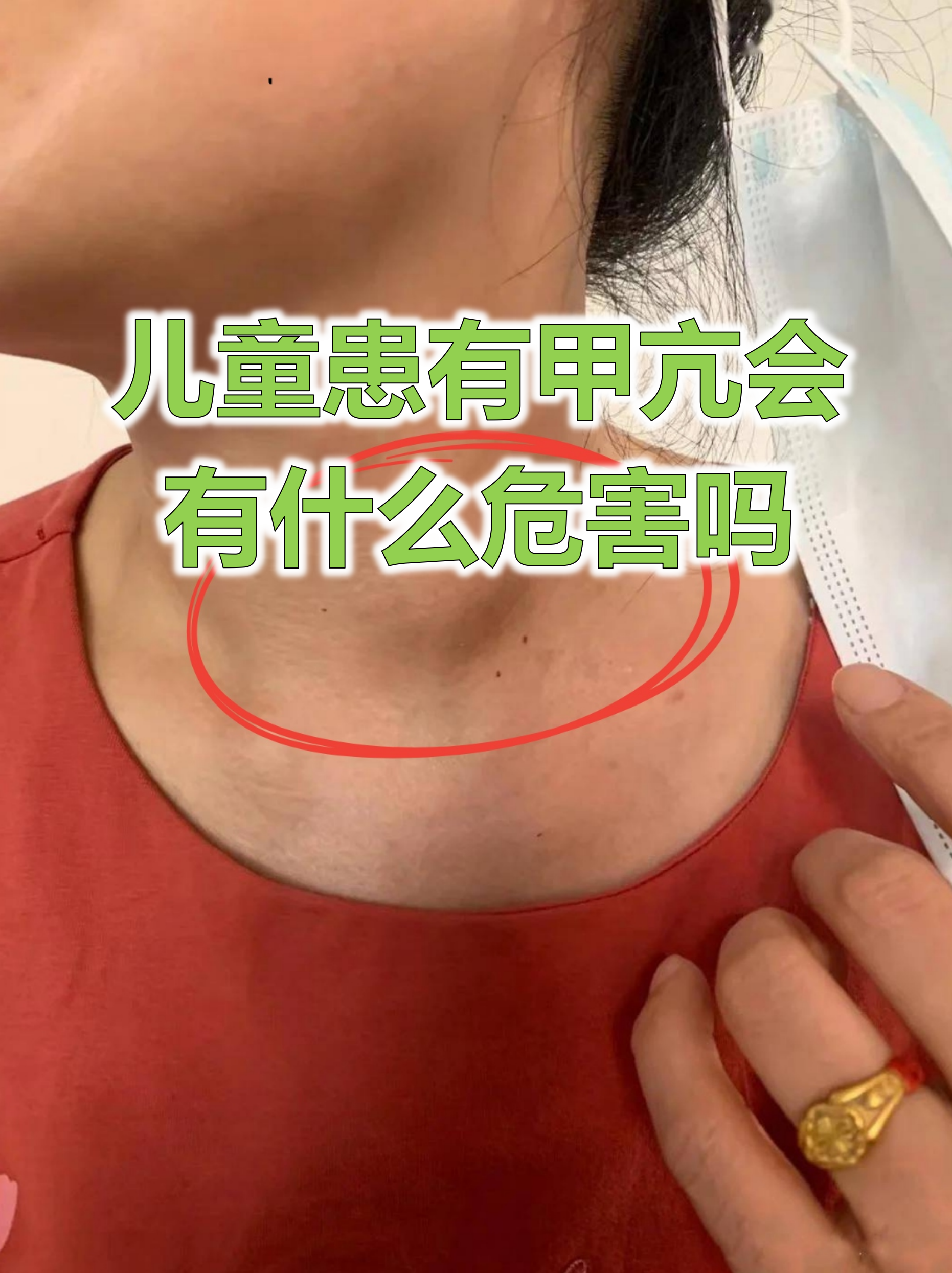 甲状腺激素高的原因有哪些