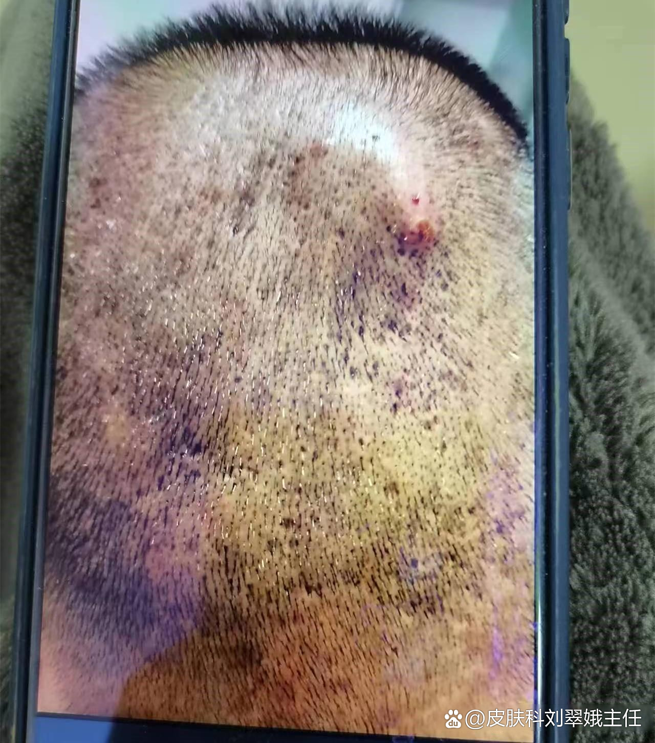 头上长脓包,怎么处理?