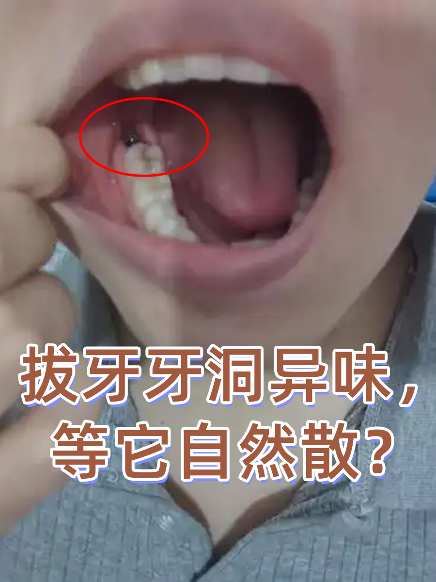 拔牙有什么危害