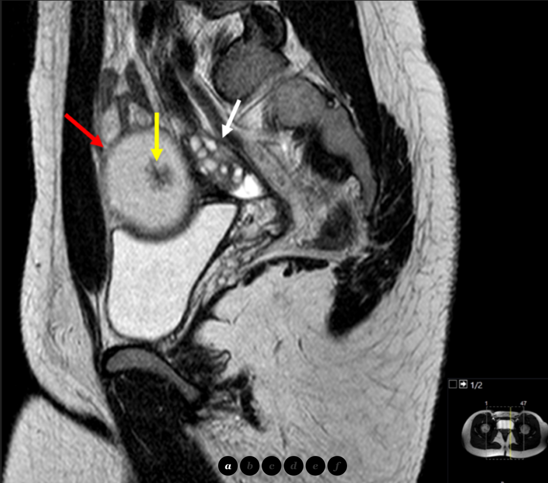 卵巢囊腺瘤是什么