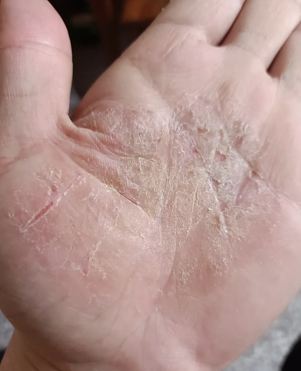 手心痒痒是怎么回事?