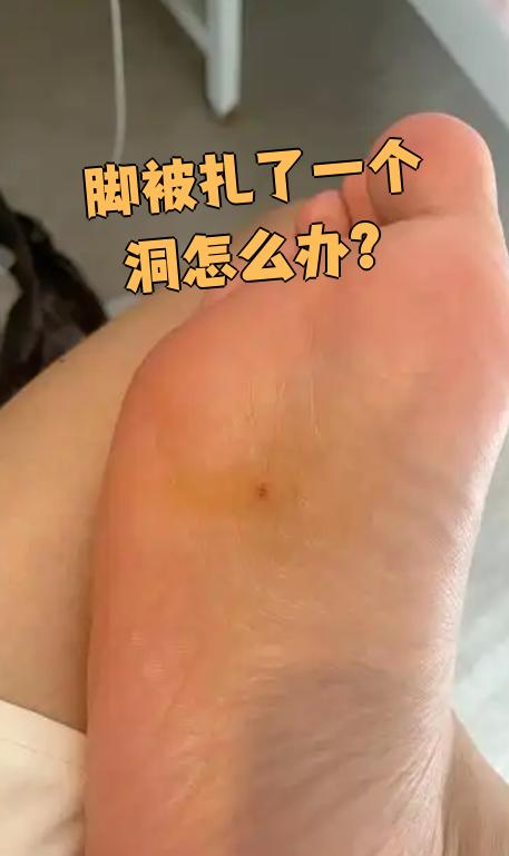 脚被钉子扎到了怎么办