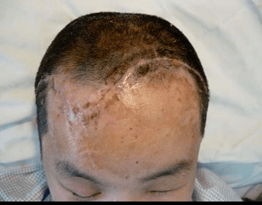 开颅手术的后遗症有什么?