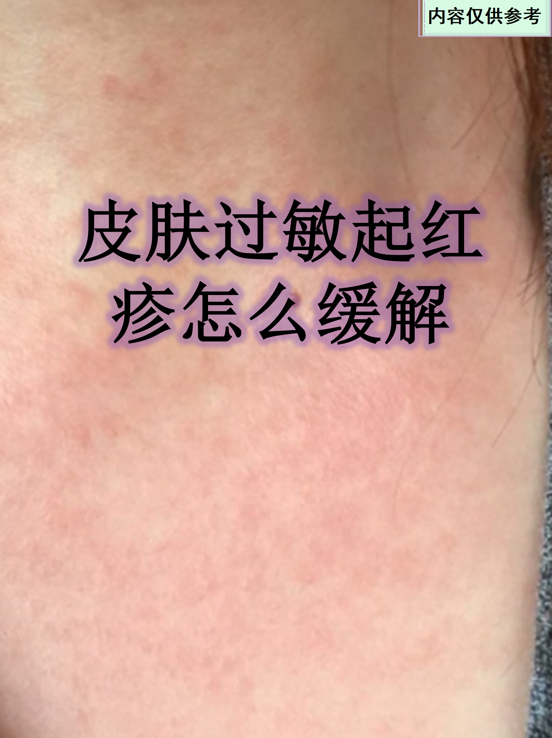 皮肤过敏痒如何止痒快速