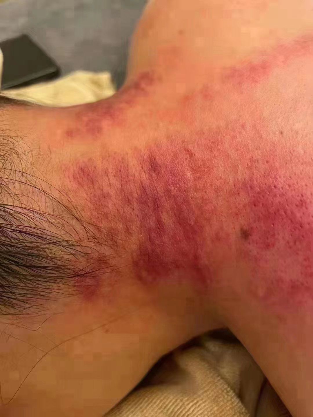 刮痧能对颈椎病有效吗