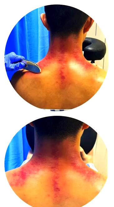 刮痧能对颈椎病有效吗