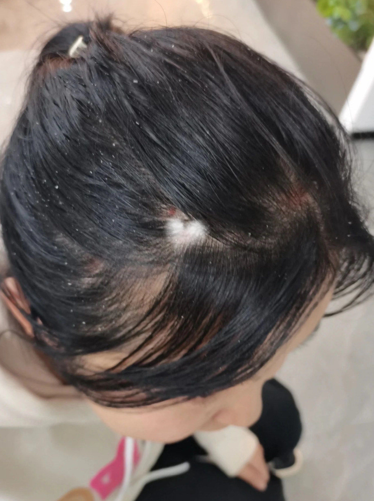 脂溢性皮炎会自愈吗