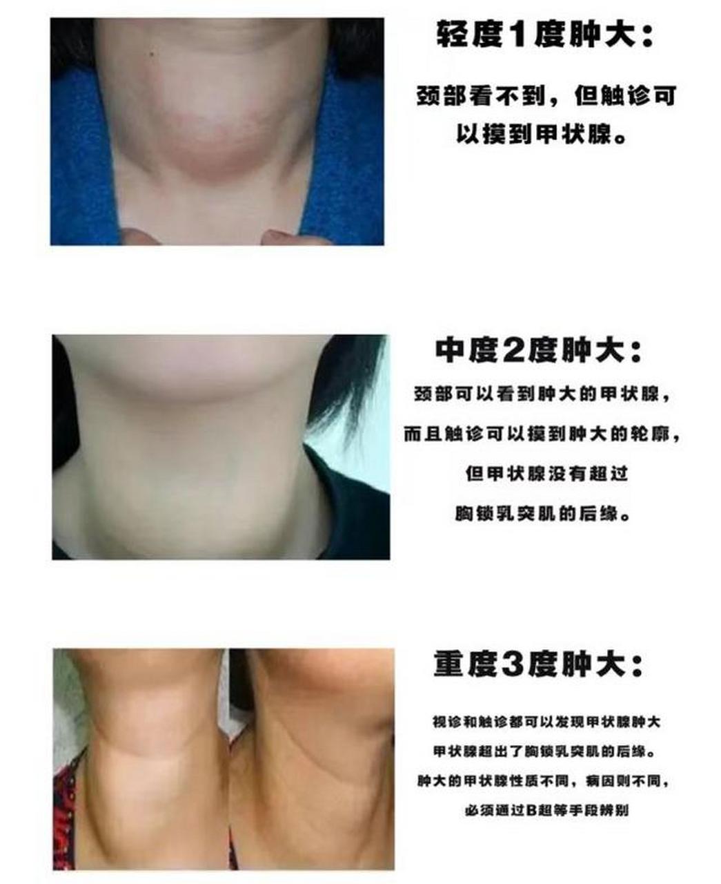 甲状腺肿大有哪些症状?