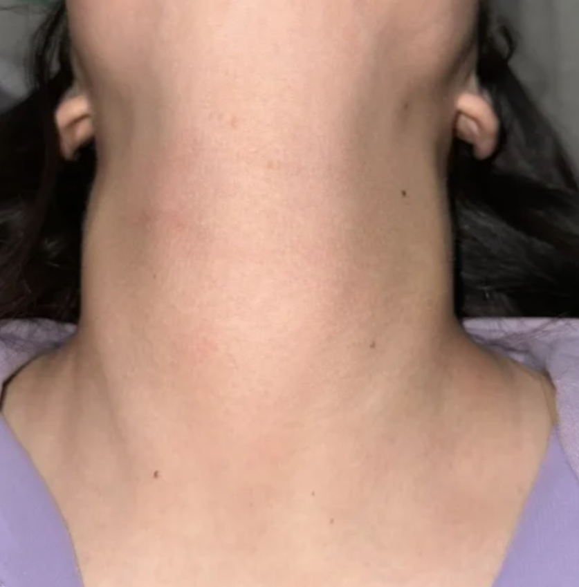 甲状腺肿大有哪些症状?