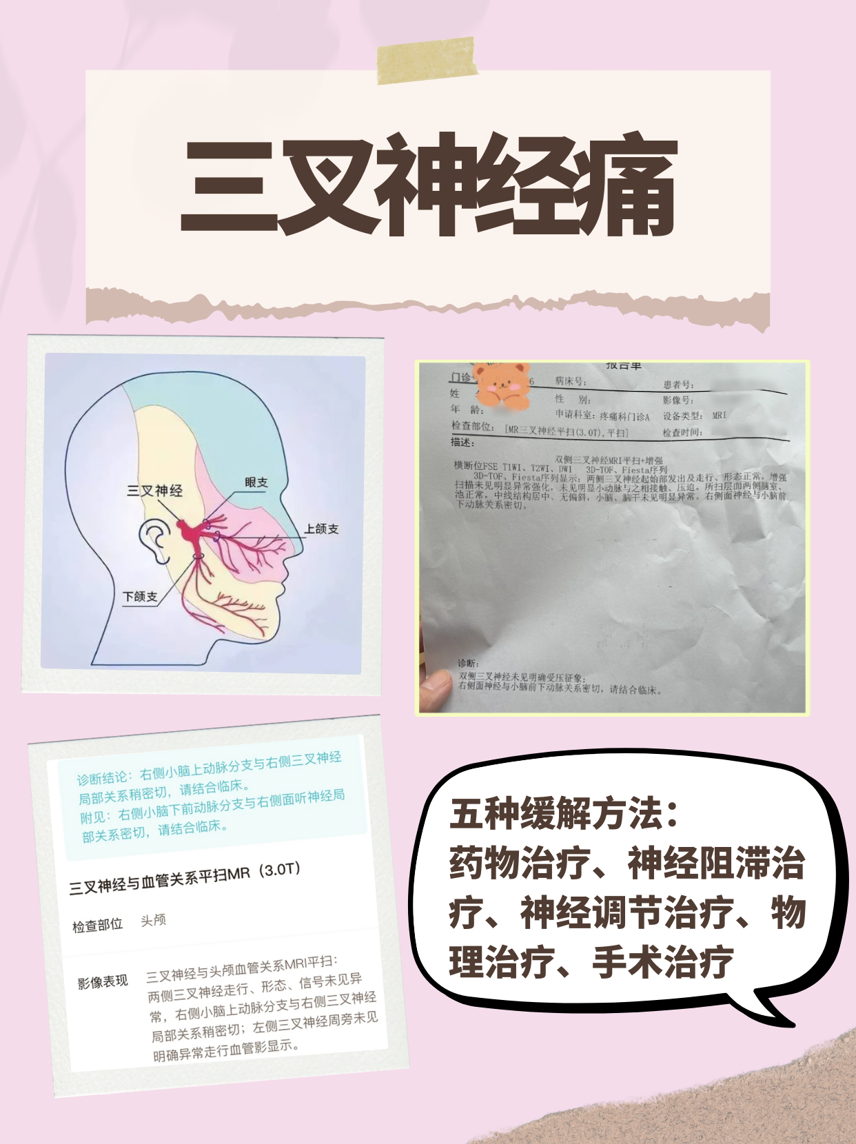 三叉神经疼症状是什么