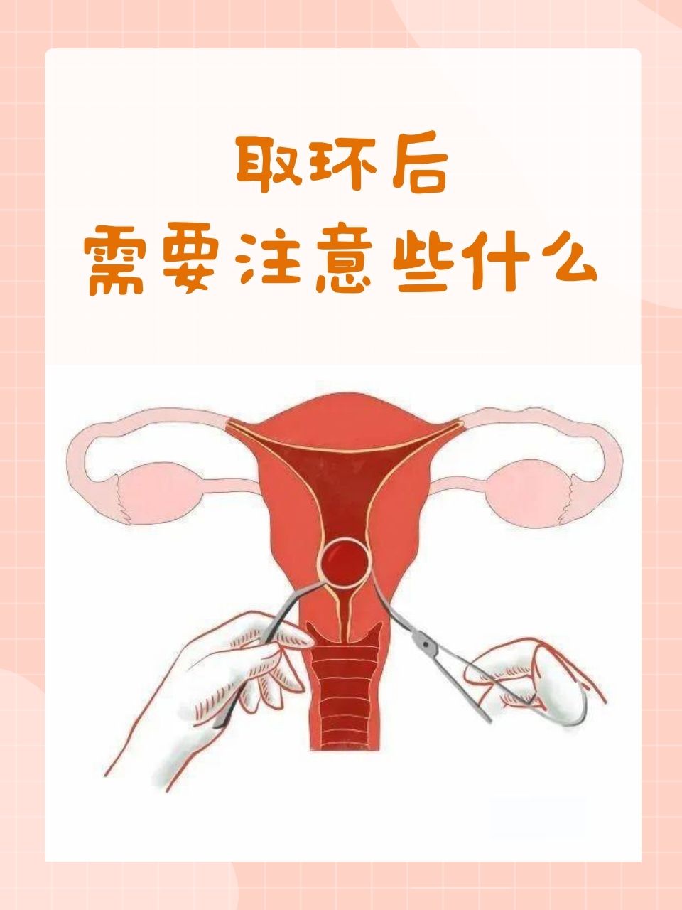 上环后还会怀孕吗