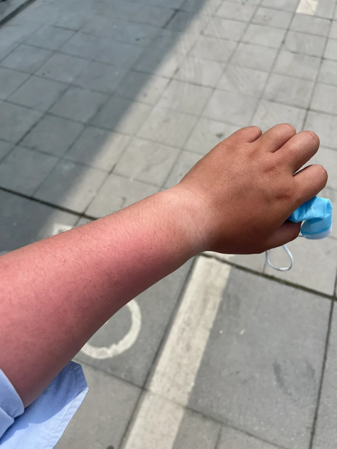 日光性皮炎能根治吗