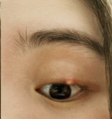 上眼睑内长了个小白点怎么办