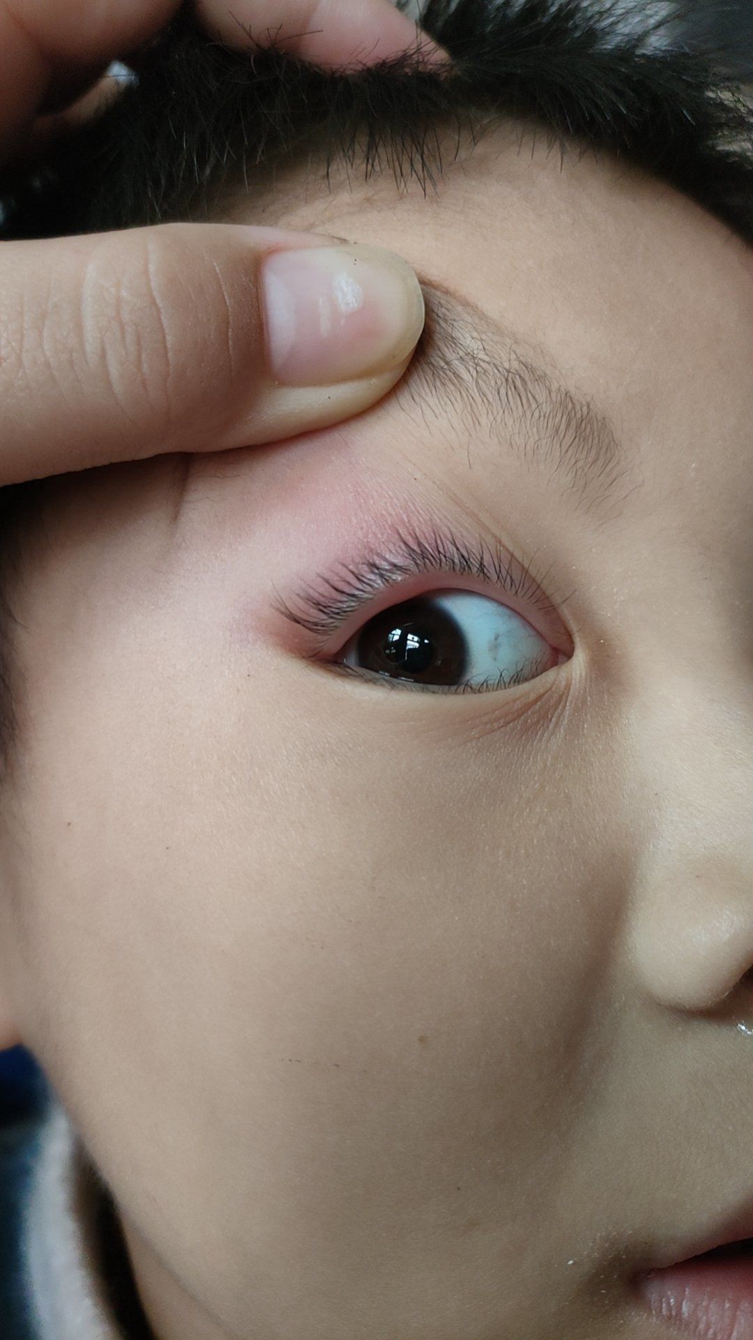 上眼睑内长了个小白点怎么办