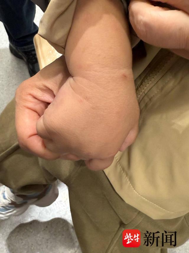 疥疮完了身上全是这种印子