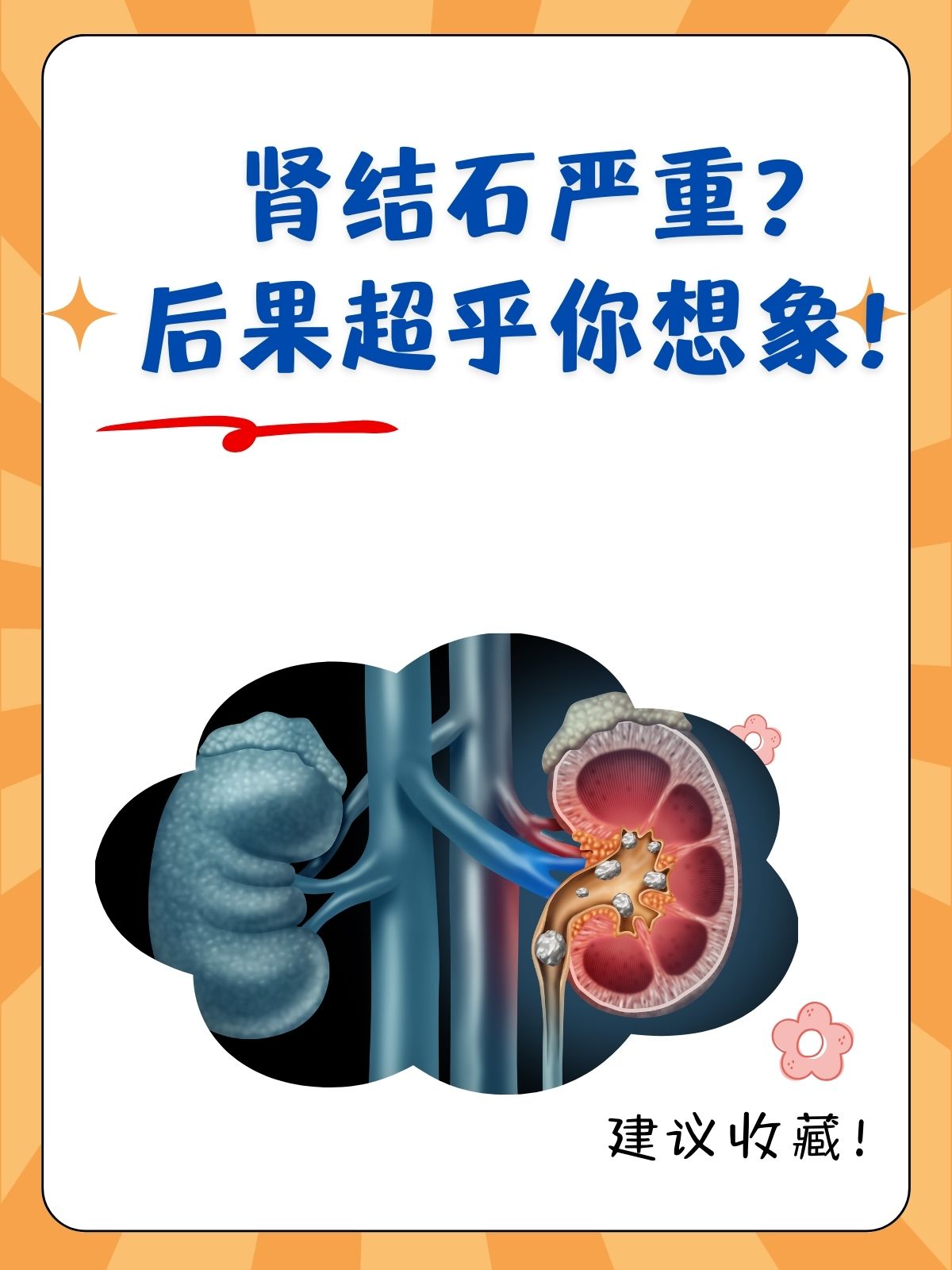 肾结石是什么原因引起的?