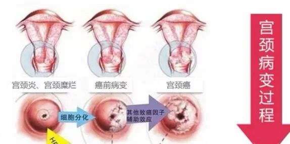 阴道炎是怎么形成的