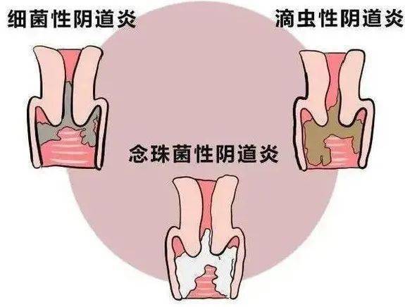 阴道炎是怎么形成的