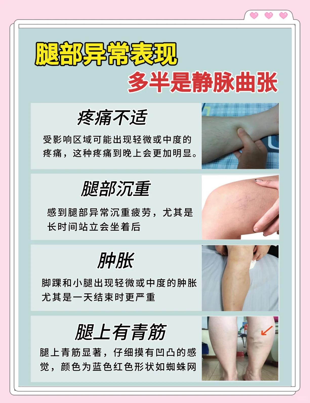 静脉曲张的主要临床症状有什么