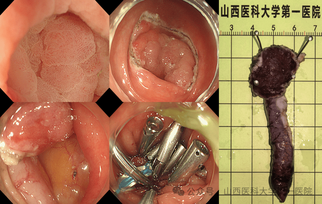 阑尾炎手术微创好还是开刀好