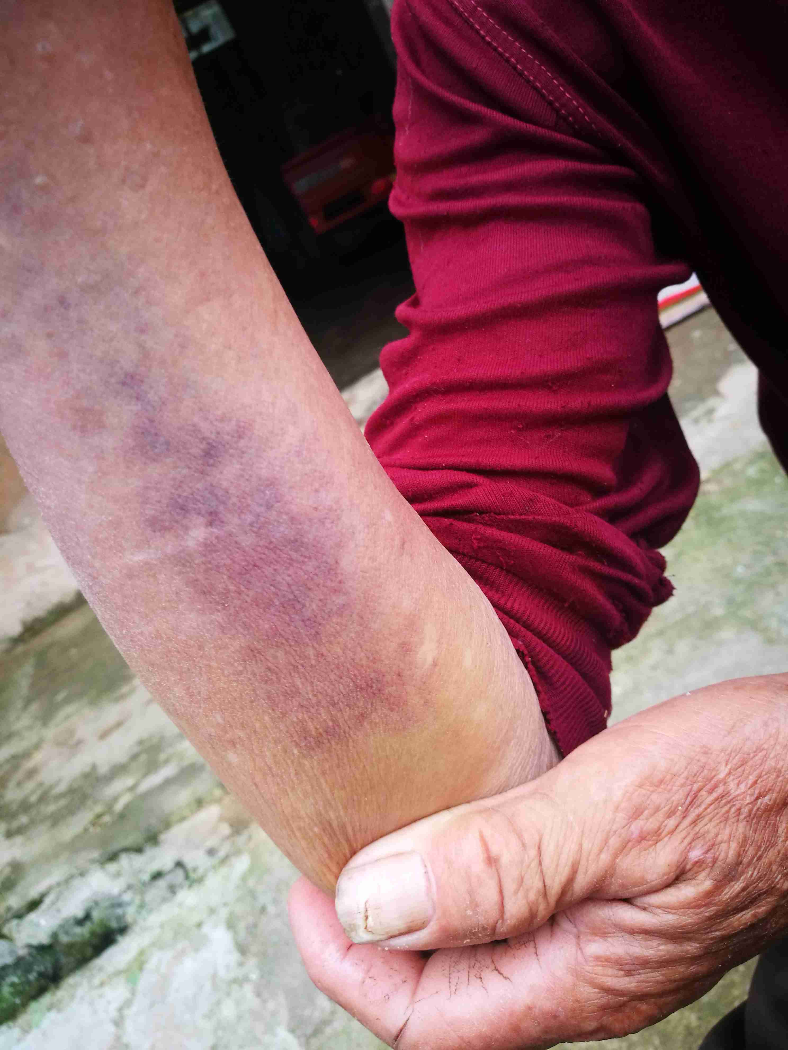 身体出现红色小血点,不痛不痒