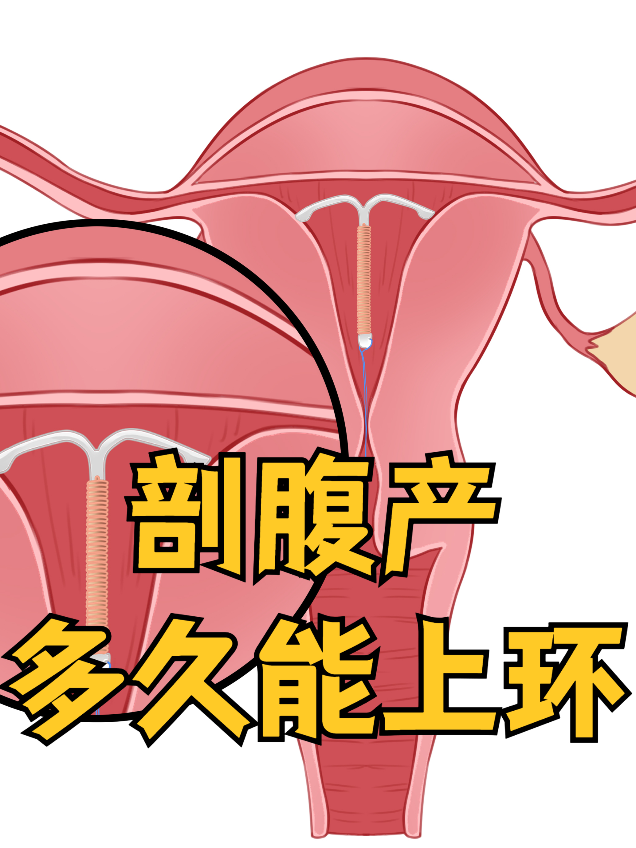 无痛人流后多久能上环