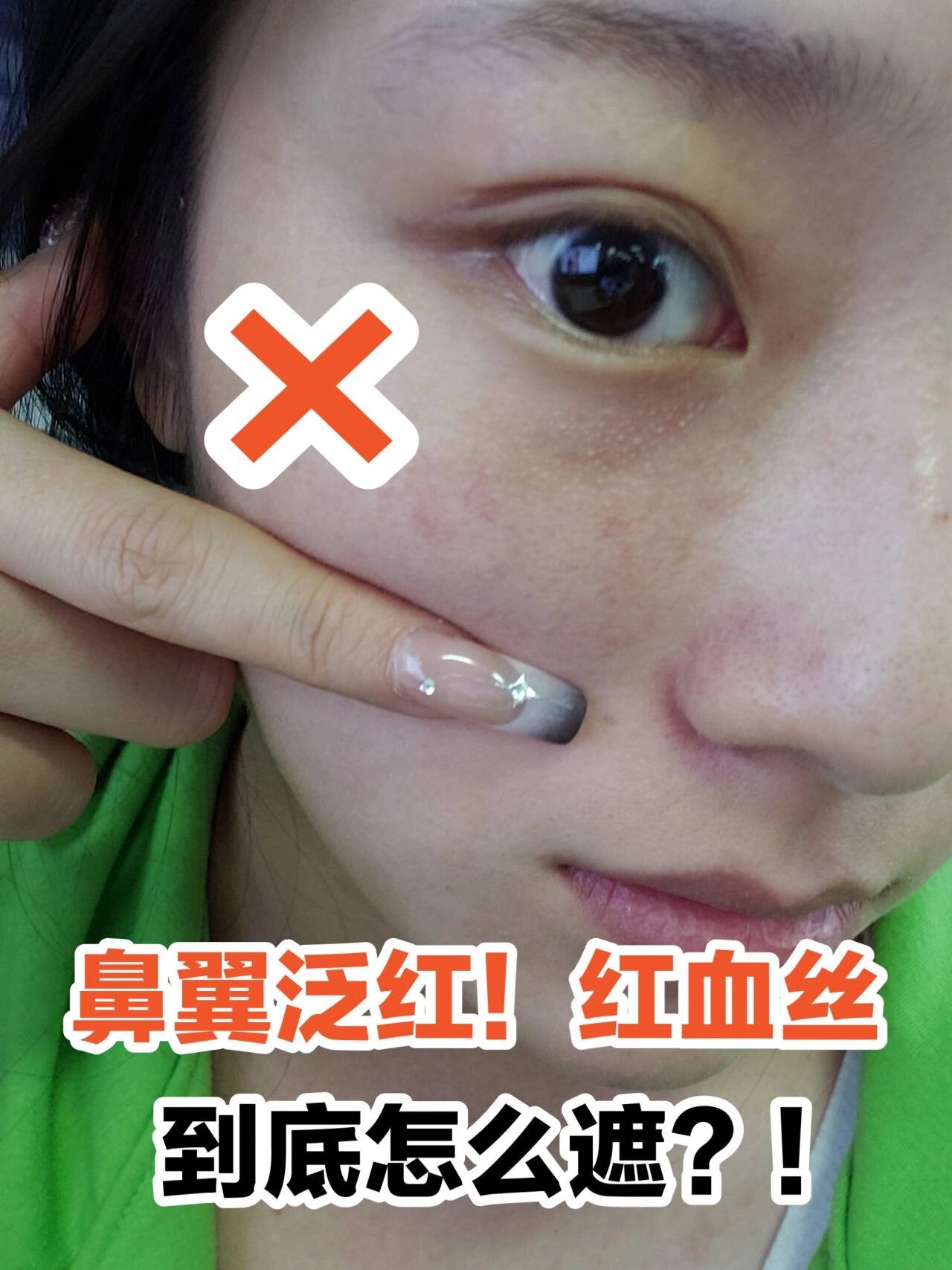 鼻子上有红血丝怎么回事