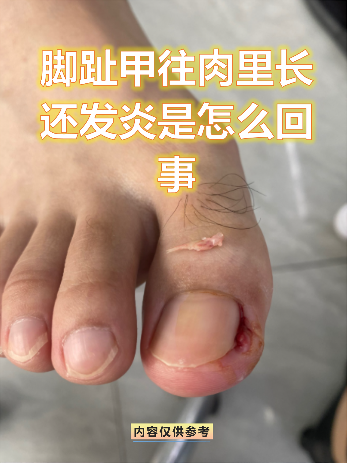 脚趾甲往肉里长怎么办?