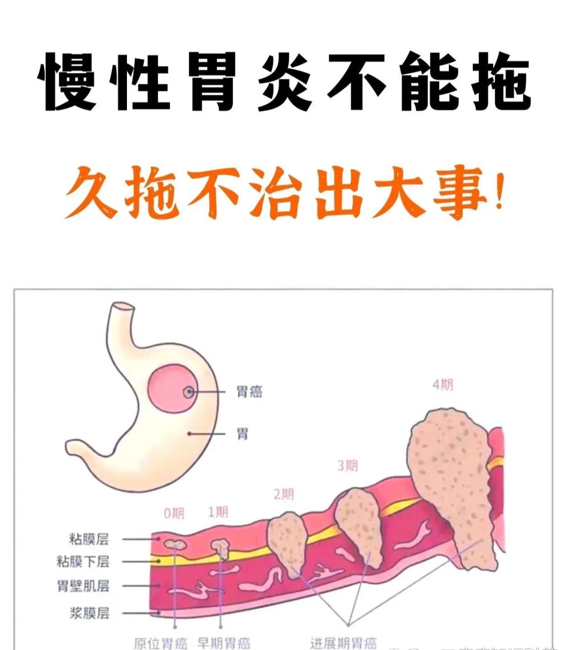 浅表性胃炎的饮食
