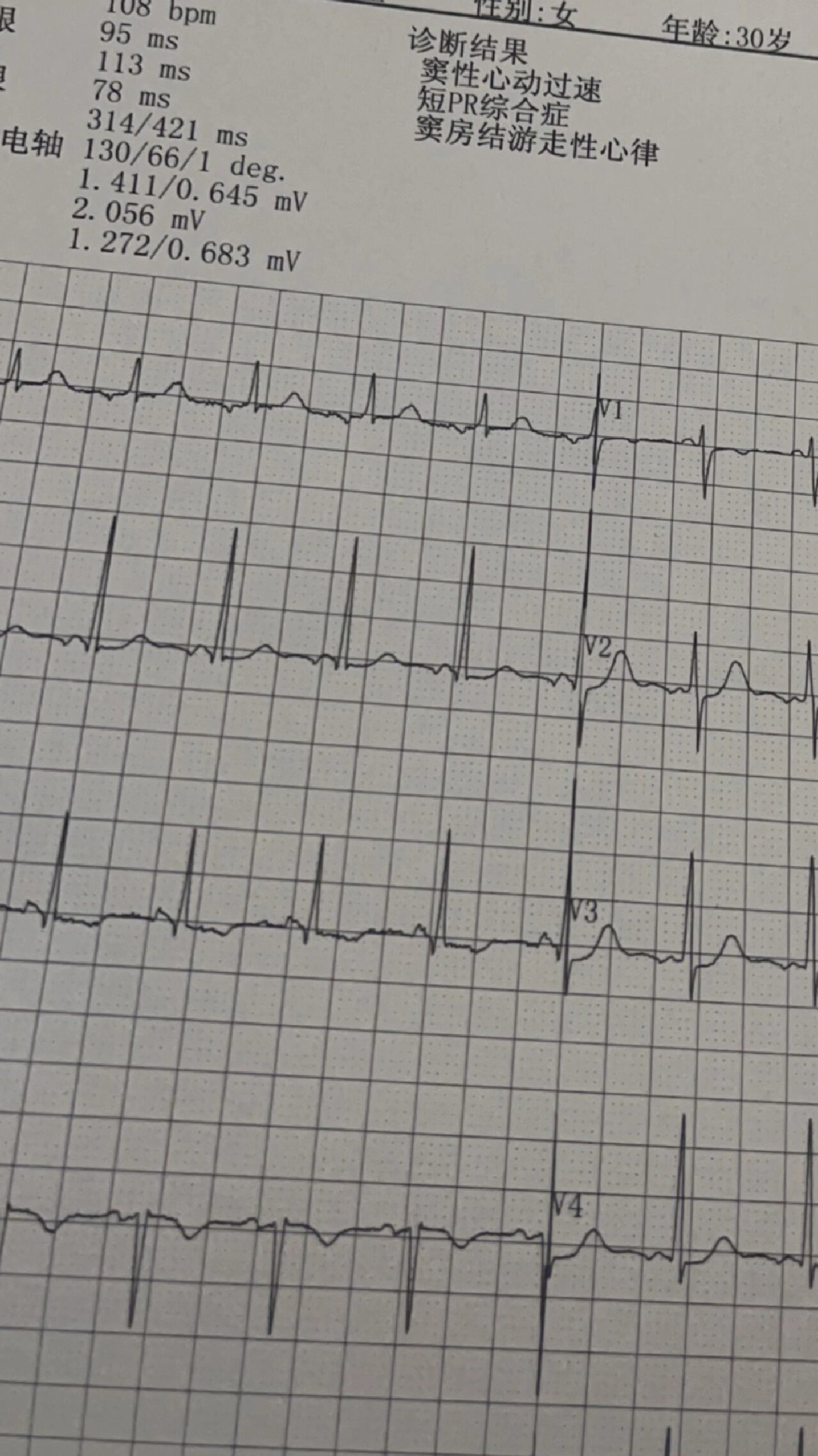 窦性心动过速110严重吗