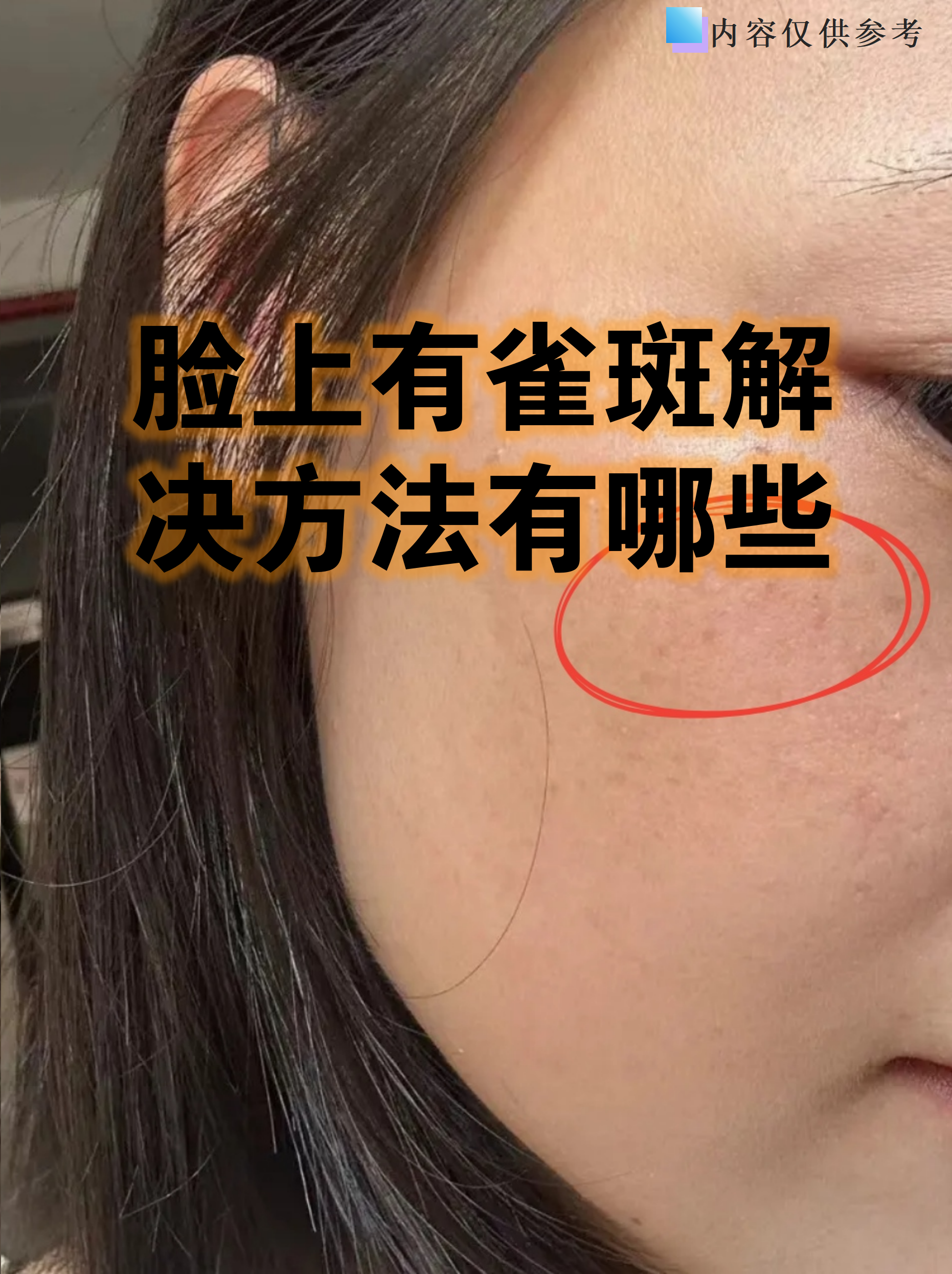 淡化遗传雀斑的小妙招