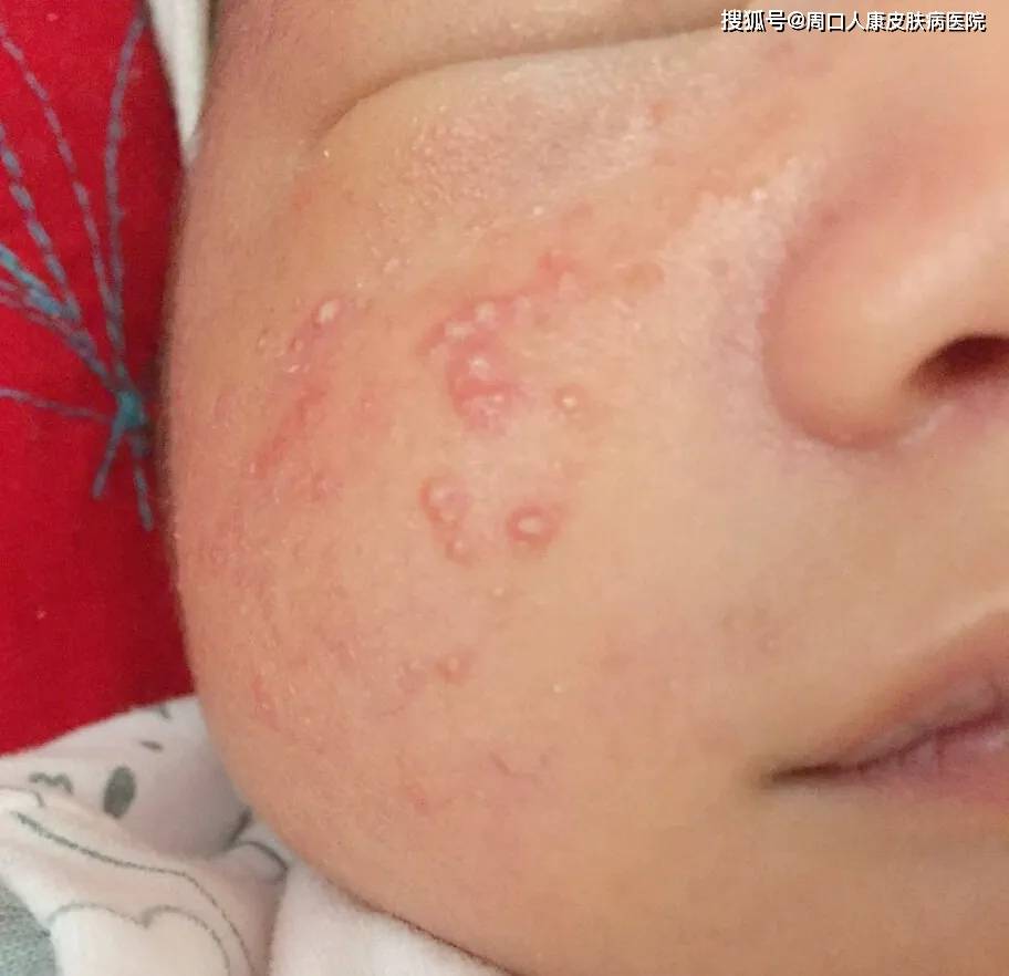宝宝脸上的小疙瘩是什么