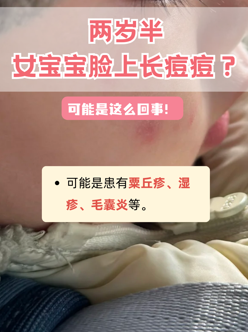 宝宝脸上的小疙瘩是什么
