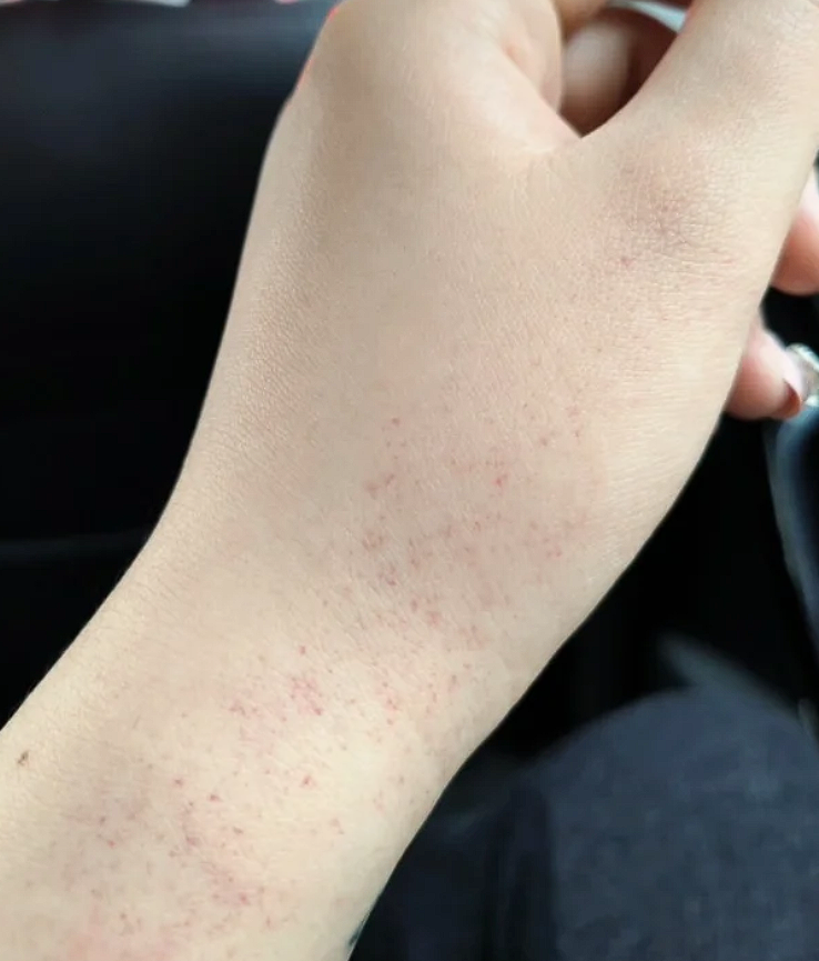 手臂上很多红血点怎么回事